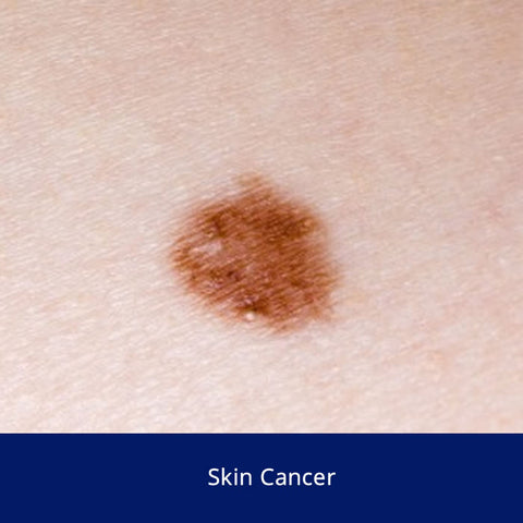 Skin Cancer Safety Talk